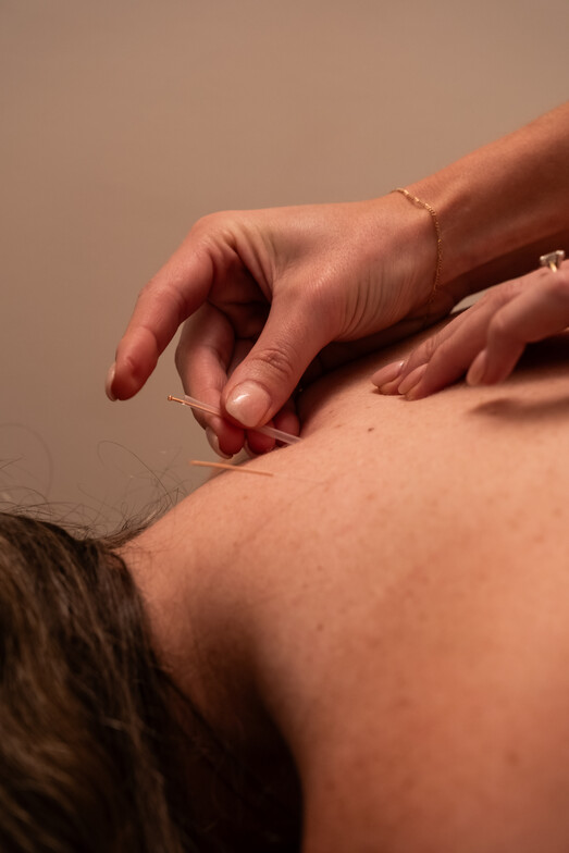 Red deer chiropractor performing dry needling or IMS to patient